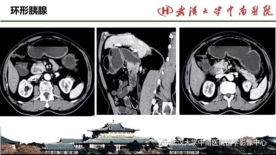 【PPT】胰腺正常解剖及形态变异、先天性疾病