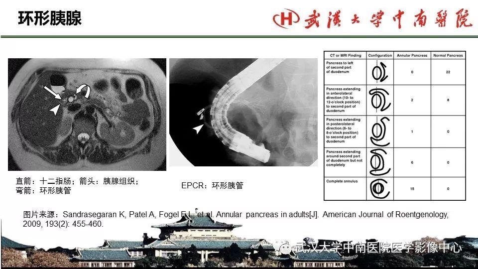 【PPT】胰腺正常解剖及形态变异、先天性疾病