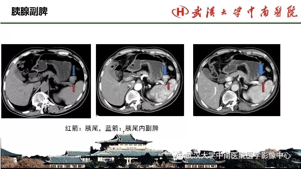 【PPT】胰腺正常解剖及形态变异、先天性疾病