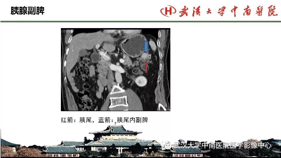 【PPT】胰腺正常解剖及形态变异、先天性疾病