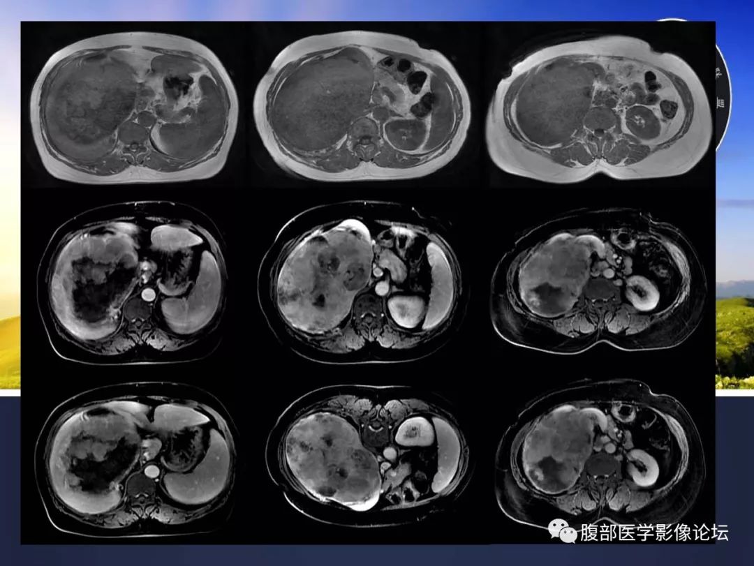 【病例】右肾嫌色细胞癌伴肉瘤样分化1例CT及MR影像