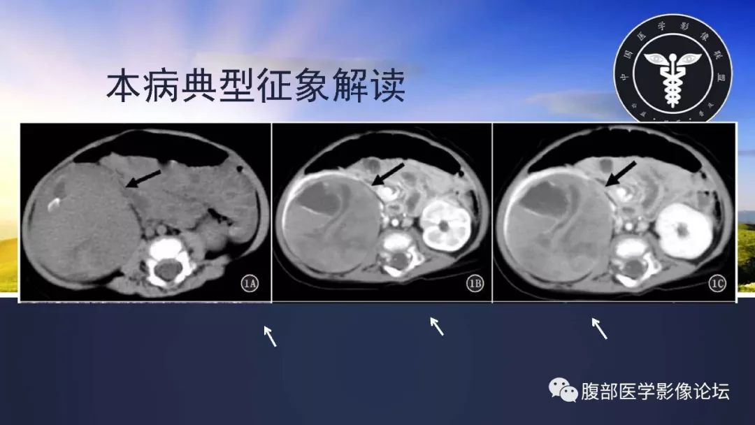 【病例】右肾嫌色细胞癌伴肉瘤样分化1例CT及MR影像