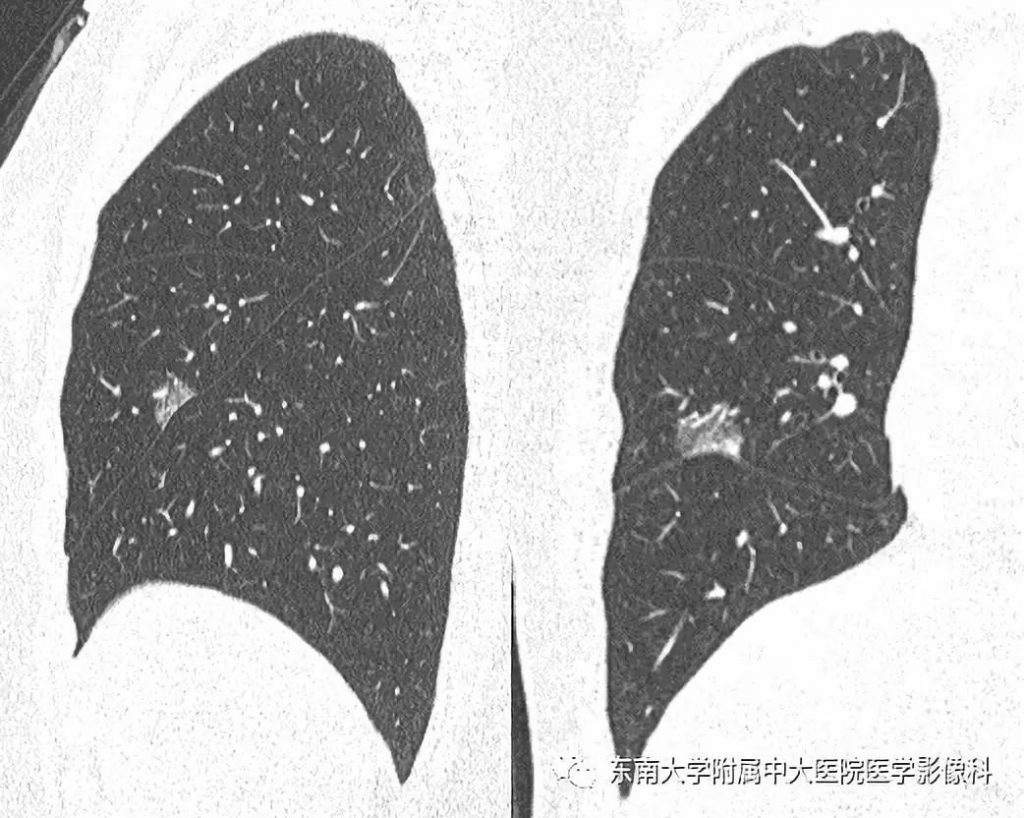 【病例】早期肺癌2例CT影像