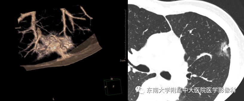 【病例】早期肺癌2例CT影像