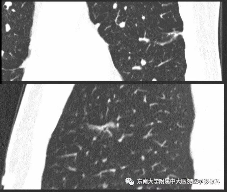 【病例】早期肺癌2例CT影像