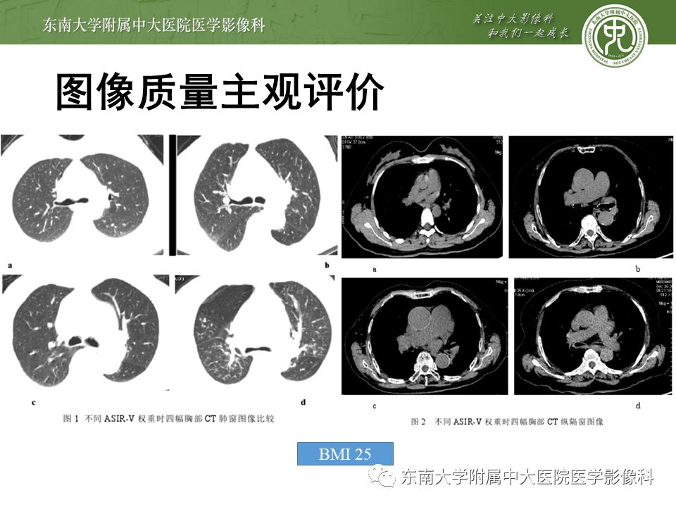 【病例】早期肺癌2例CT影像