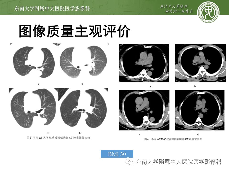 【病例】早期肺癌2例CT影像