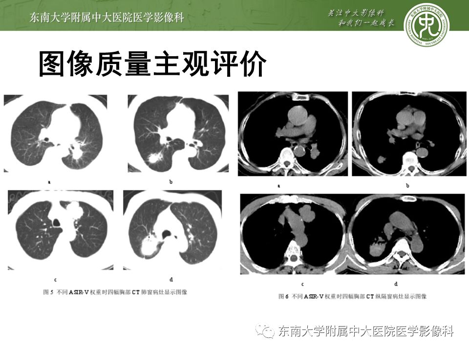 【病例】早期肺癌2例CT影像