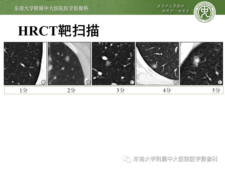 【病例】早期肺癌2例CT影像