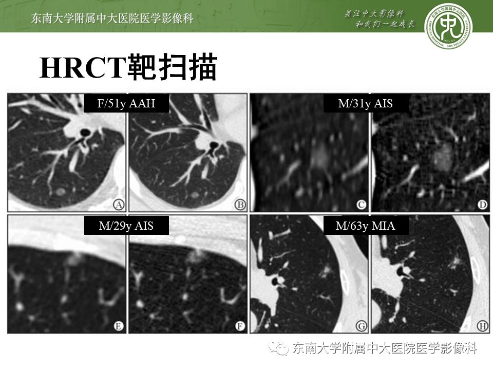 【病例】早期肺癌2例CT影像