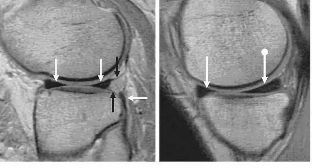 阅片技巧分享：正常与异常半月板 MRI
