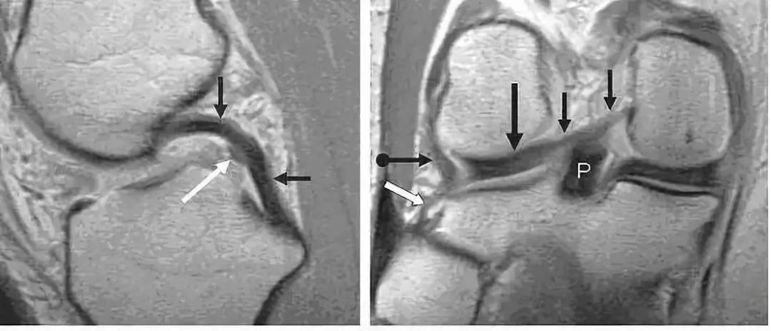 阅片技巧分享:正常与异常半月板 MRI 阅片技巧分享:正常与异常半月板 MRI