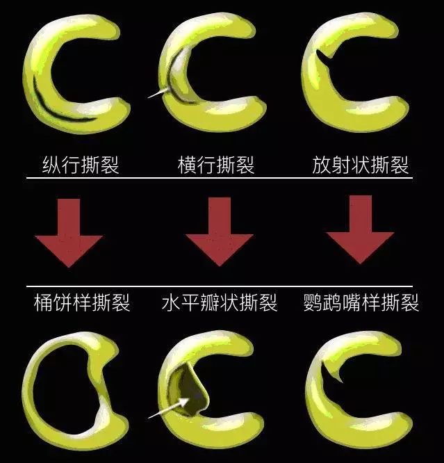 阅片技巧分享:正常与异常半月板 MRI 阅片技巧分享:正常与异常半月板 MRI