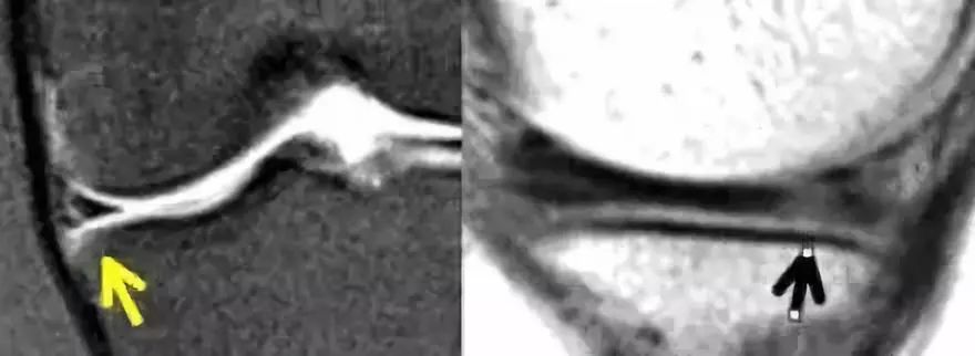 阅片技巧分享:正常与异常半月板 MRI 阅片技巧分享:正常与异常半月板 MRI
