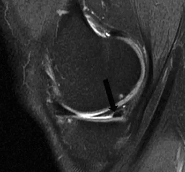 阅片技巧分享:正常与异常半月板 MRI 阅片技巧分享:正常与异常半月板 MRI