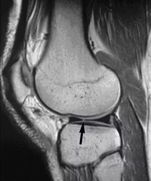 阅片技巧分享:正常与异常半月板 MRI 阅片技巧分享:正常与异常半月板 MRI
