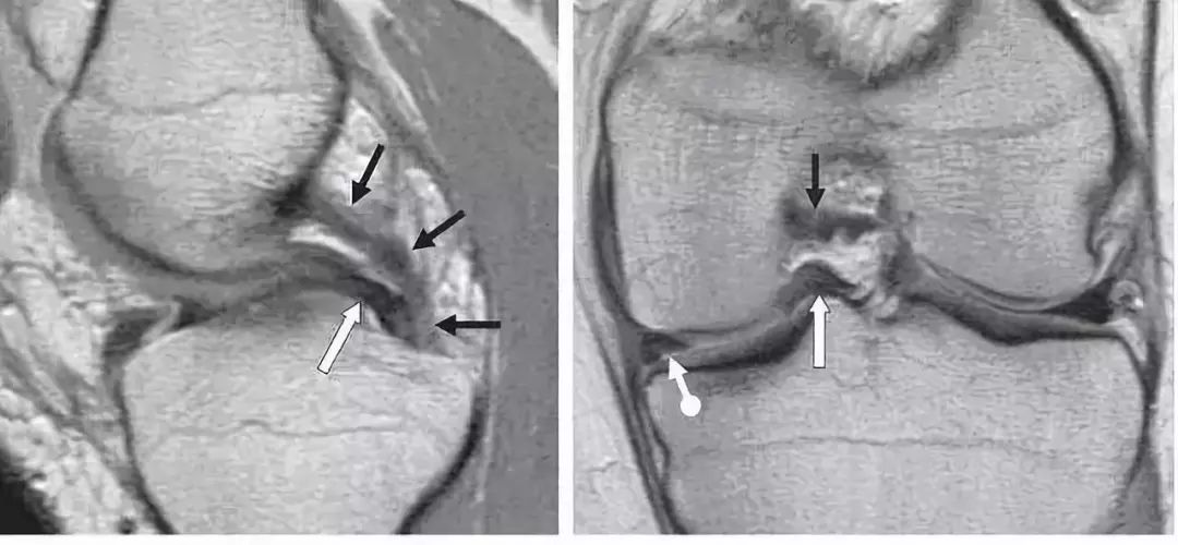 阅片技巧分享:正常与异常半月板 MRI 阅片技巧分享:正常与异常半月板 MRI