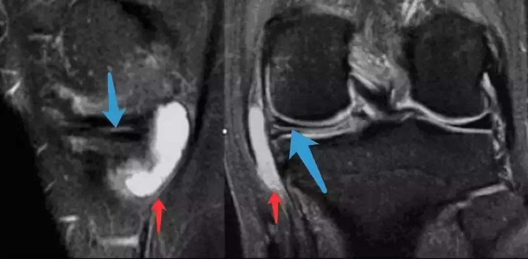 阅片技巧分享:正常与异常半月板 MRI 阅片技巧分享:正常与异常半月板 MRI
