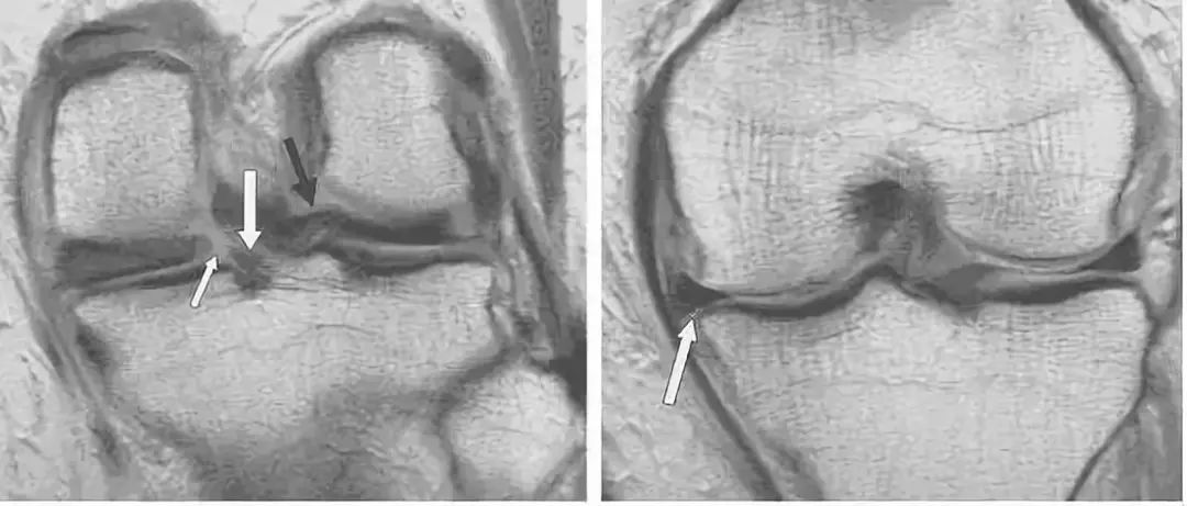阅片技巧分享:正常与异常半月板 MRI 阅片技巧分享:正常与异常半月板 MRI