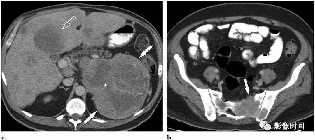 肾上腺嗜铬细胞瘤影像表现 肾上腺嗜铬细胞瘤影像表现