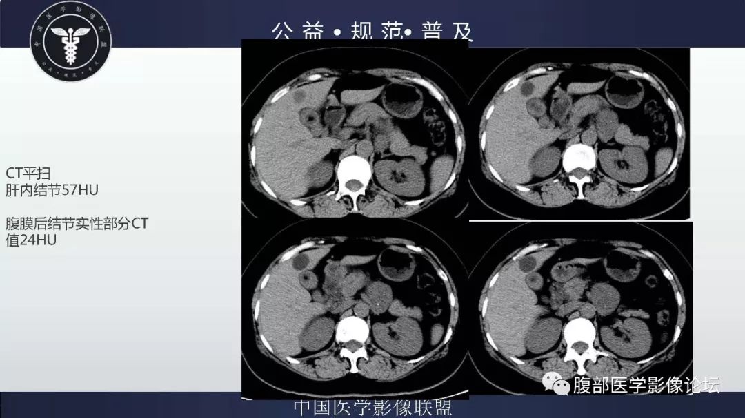 【病例】腹膜后神经鞘瘤及肝腺瘤1例CT