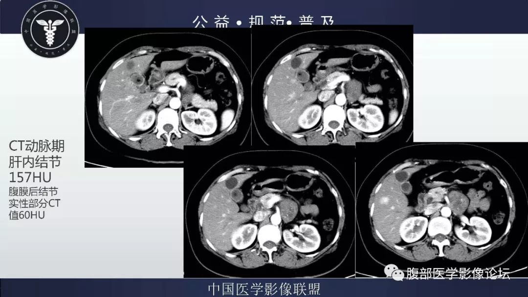【病例】腹膜后神经鞘瘤及肝腺瘤1例CT