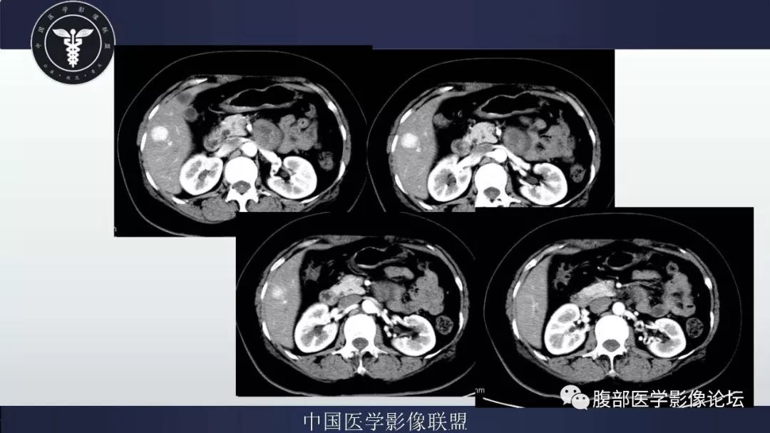 【病例】腹膜后神经鞘瘤及肝腺瘤1例CT