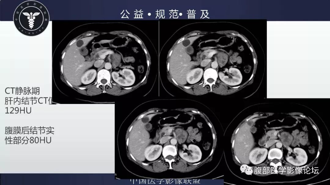【病例】腹膜后神经鞘瘤及肝腺瘤1例CT