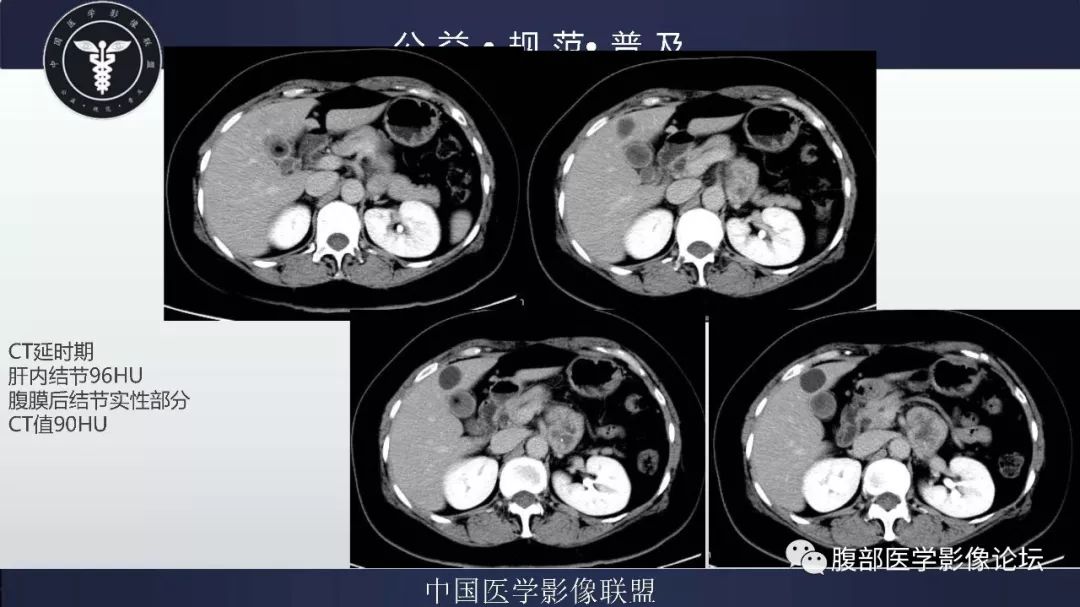 【病例】腹膜后神经鞘瘤及肝腺瘤1例CT