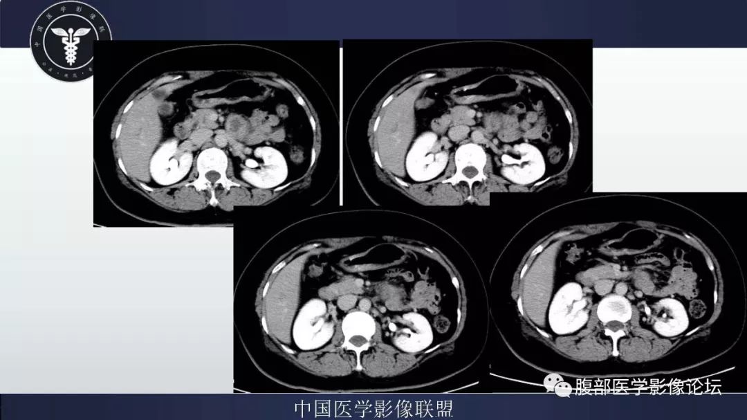 【病例】腹膜后神经鞘瘤及肝腺瘤1例CT