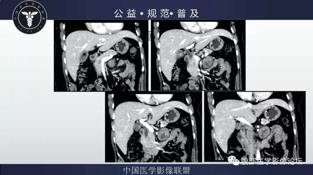 【病例】腹膜后神经鞘瘤及肝腺瘤1例CT