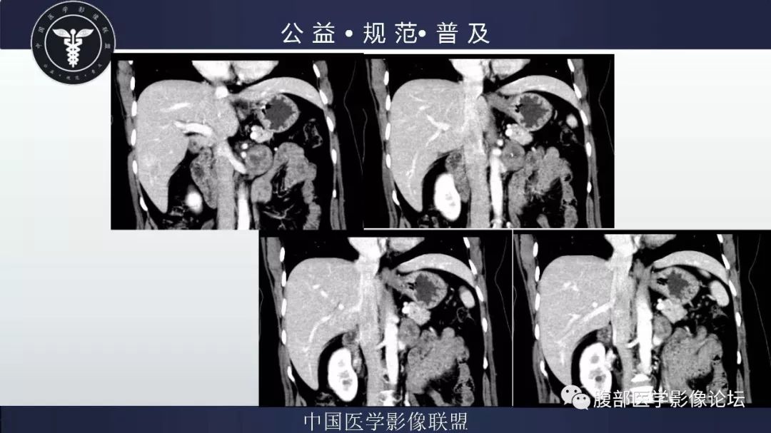 【病例】腹膜后神经鞘瘤及肝腺瘤1例CT