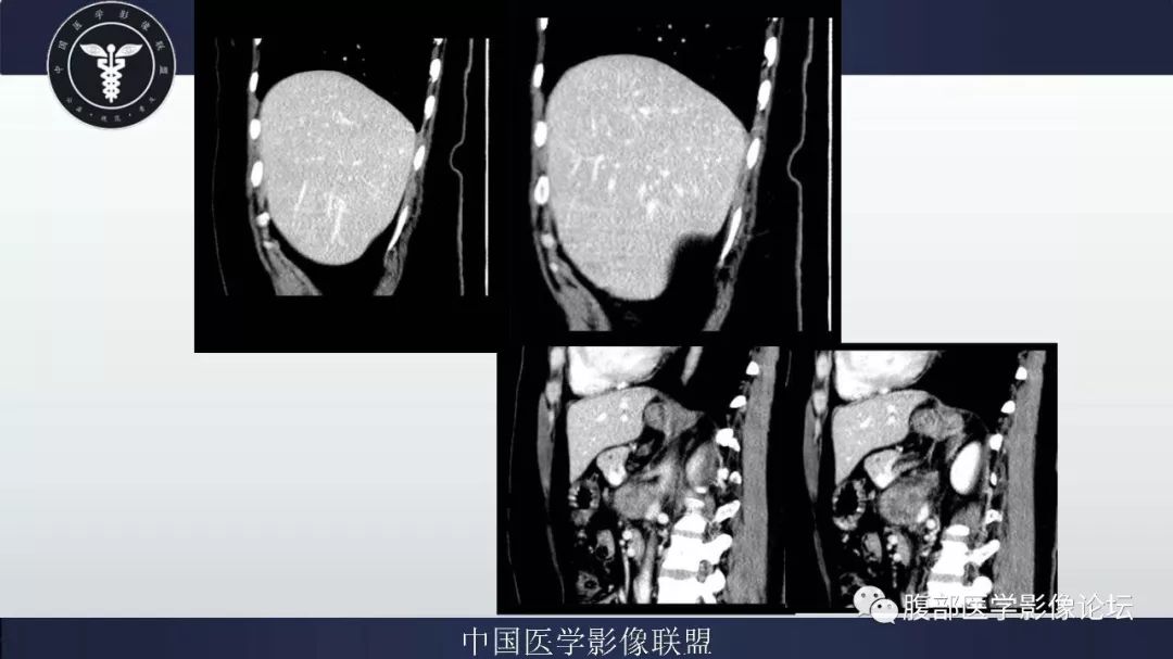 【病例】腹膜后神经鞘瘤及肝腺瘤1例CT