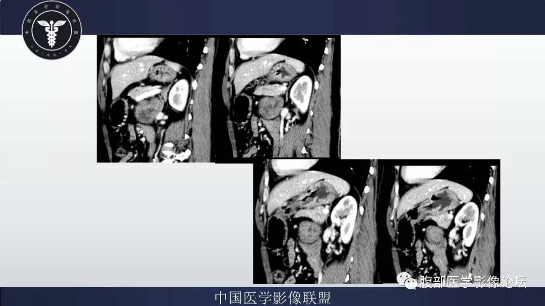 【病例】腹膜后神经鞘瘤及肝腺瘤1例CT
