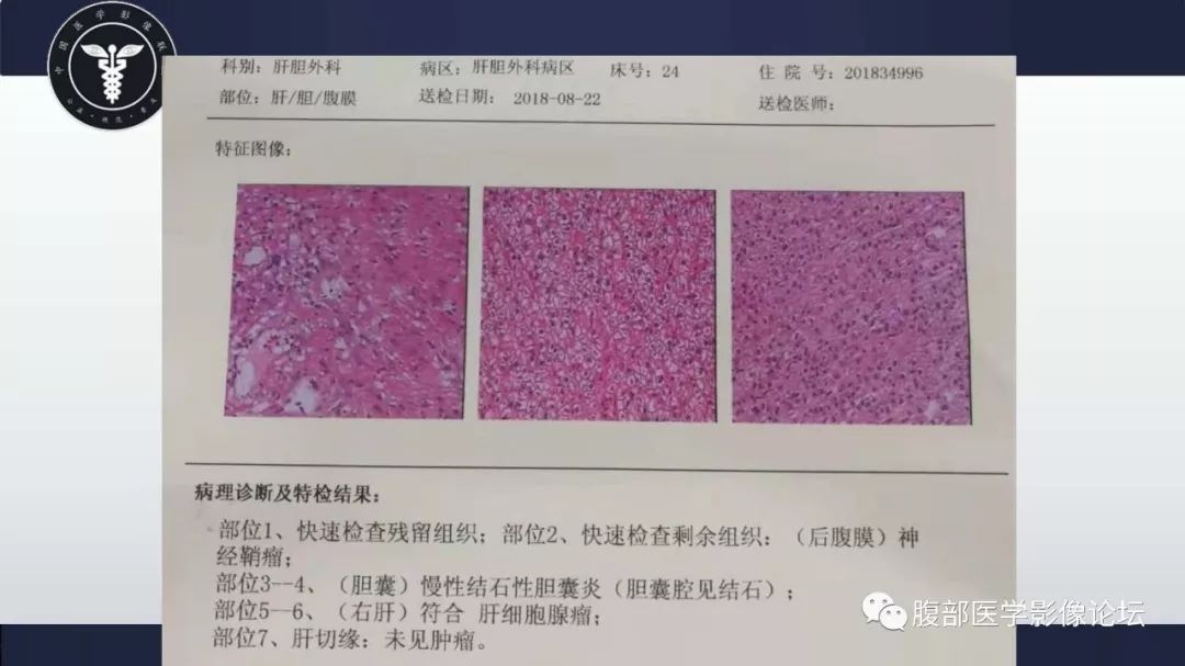 【病例】腹膜后神经鞘瘤及肝腺瘤1例CT