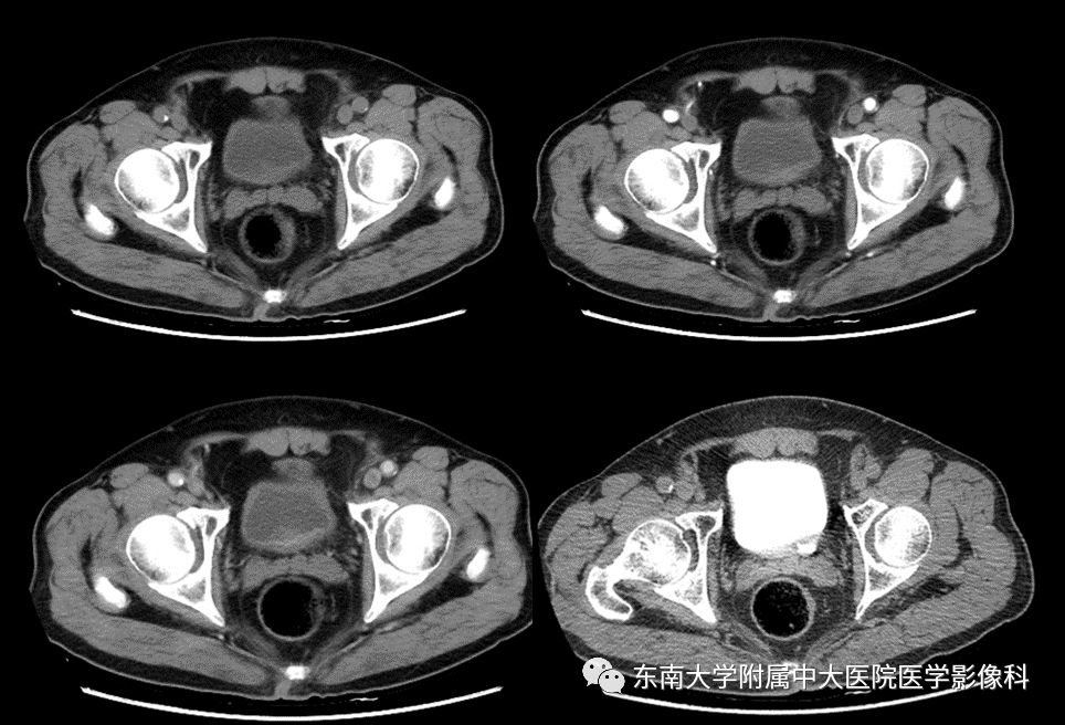 【病例】高级别乳头状尿路上皮癌VS膀胱乳头状瘤各1例CT