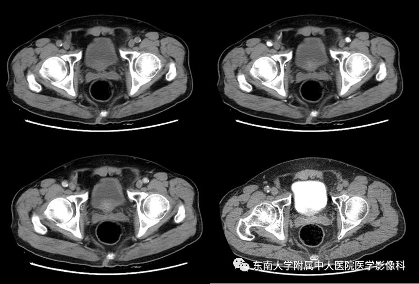 【病例】高级别乳头状尿路上皮癌VS膀胱乳头状瘤各1例CT