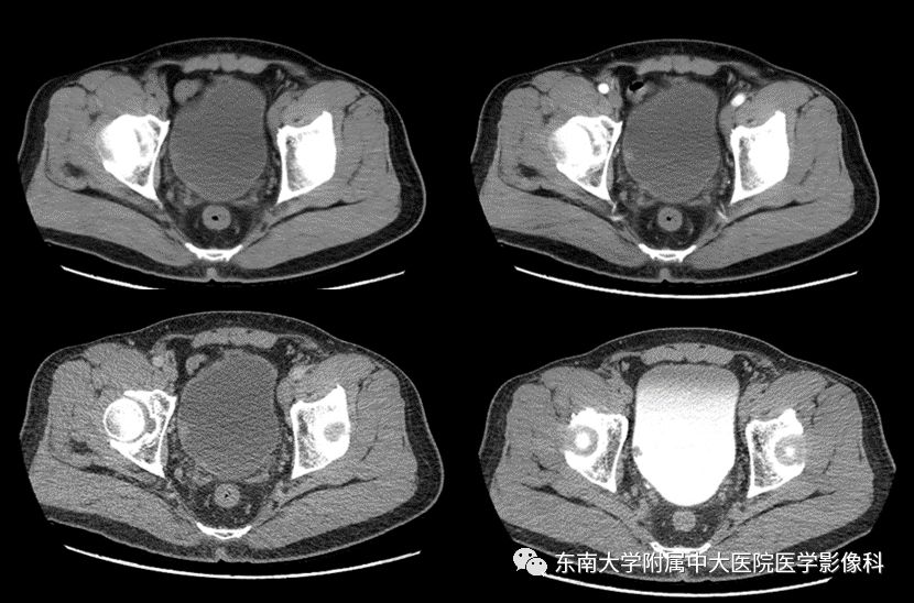 【病例】高级别乳头状尿路上皮癌VS膀胱乳头状瘤各1例CT