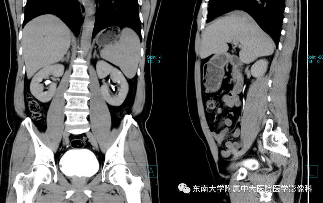 【病例】高级别乳头状尿路上皮癌VS膀胱乳头状瘤各1例CT