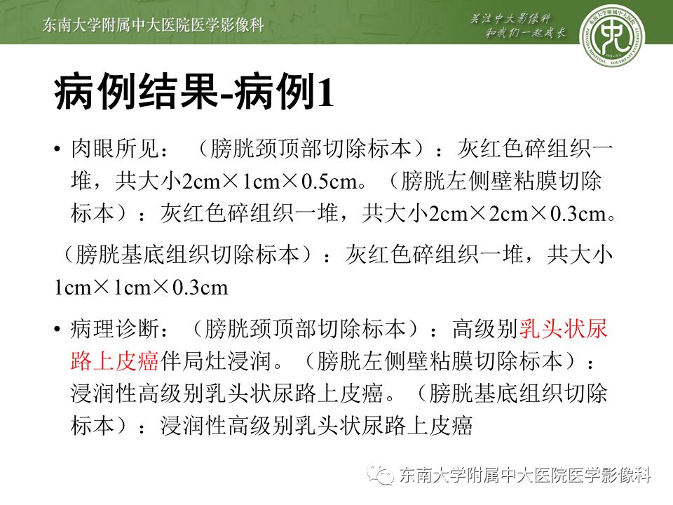 【病例】高级别乳头状尿路上皮癌VS膀胱乳头状瘤各1例CT