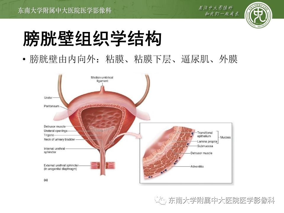 【病例】高级别乳头状尿路上皮癌VS膀胱乳头状瘤各1例CT