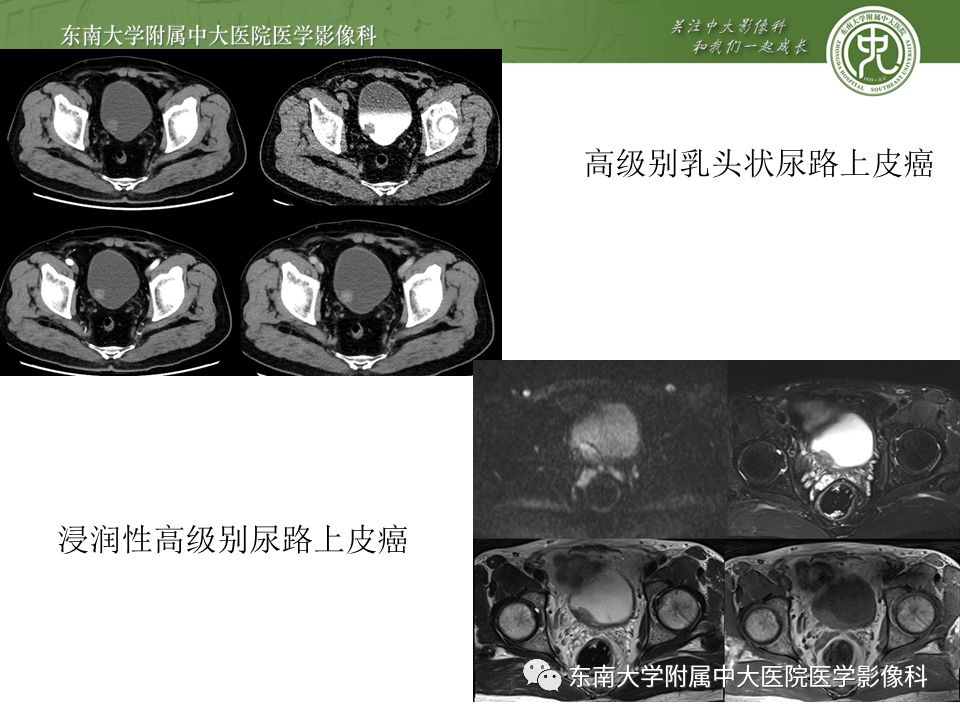 【病例】高级别乳头状尿路上皮癌VS膀胱乳头状瘤各1例CT