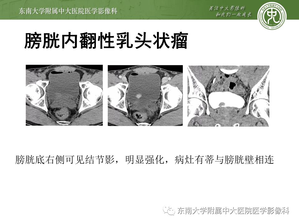 【病例】高级别乳头状尿路上皮癌VS膀胱乳头状瘤各1例CT