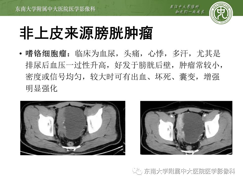 【病例】高级别乳头状尿路上皮癌VS膀胱乳头状瘤各1例CT