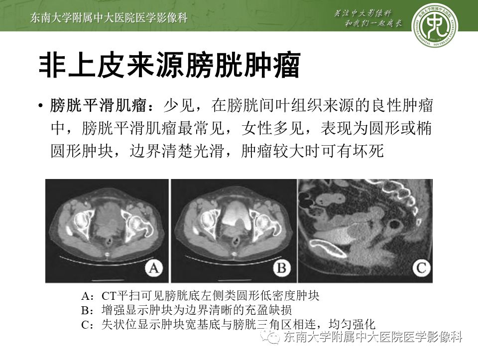 【病例】高级别乳头状尿路上皮癌VS膀胱乳头状瘤各1例CT