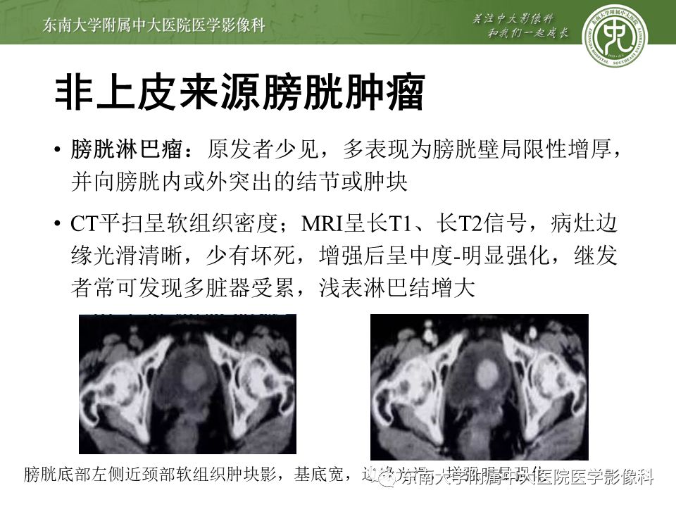 【病例】高级别乳头状尿路上皮癌VS膀胱乳头状瘤各1例CT