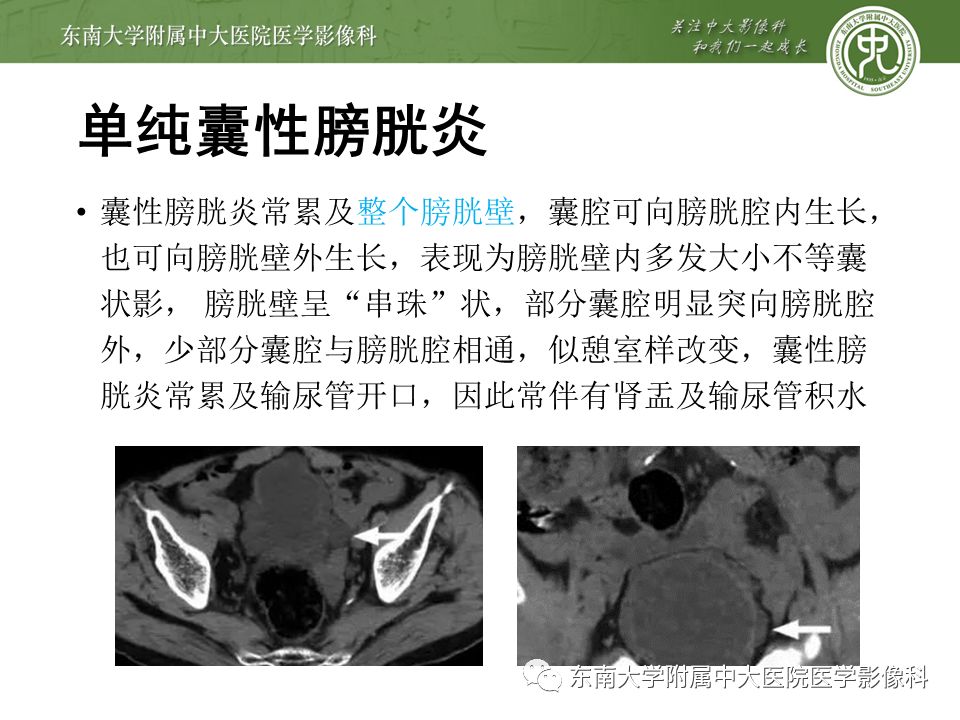 【病例】高级别乳头状尿路上皮癌VS膀胱乳头状瘤各1例CT