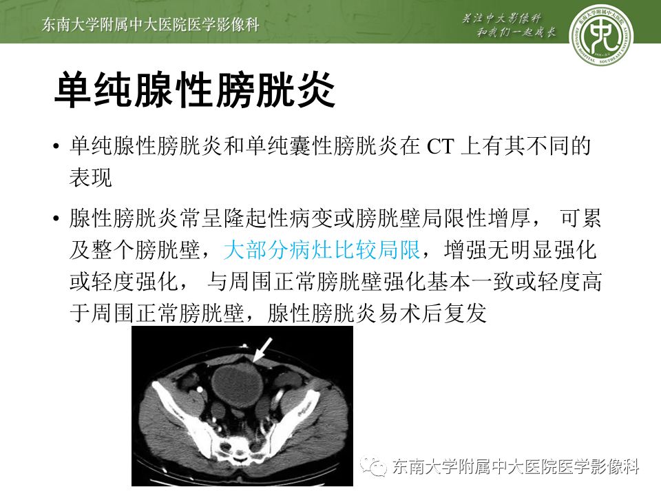 【病例】高级别乳头状尿路上皮癌VS膀胱乳头状瘤各1例CT