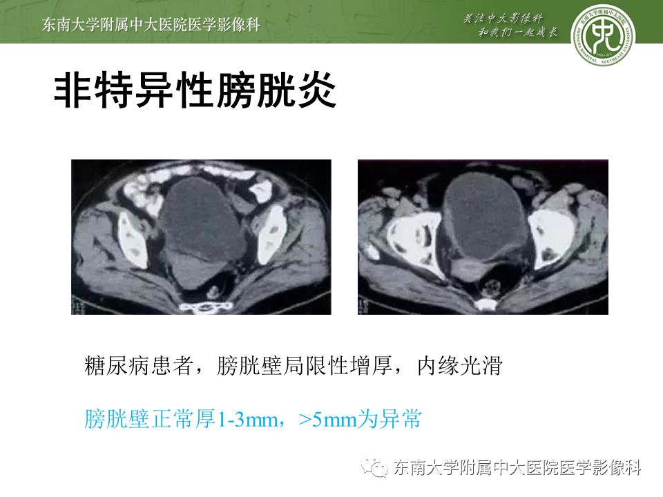 【病例】高级别乳头状尿路上皮癌VS膀胱乳头状瘤各1例CT