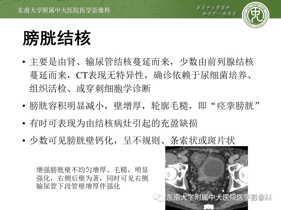 【病例】高级别乳头状尿路上皮癌VS膀胱乳头状瘤各1例CT